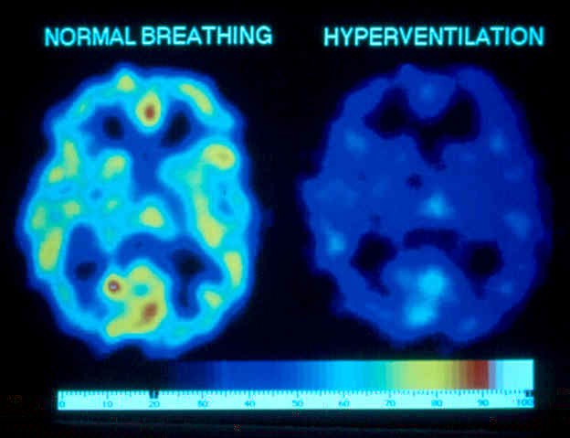 hyperventilation perfusion